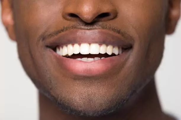 ابتسامة هوليود من اهم عمليات تجميل الاسنان في تركيا