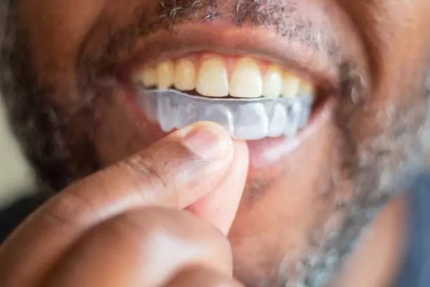 تقويم الأسنان من عمليات تجميل الاسنان في تركيا