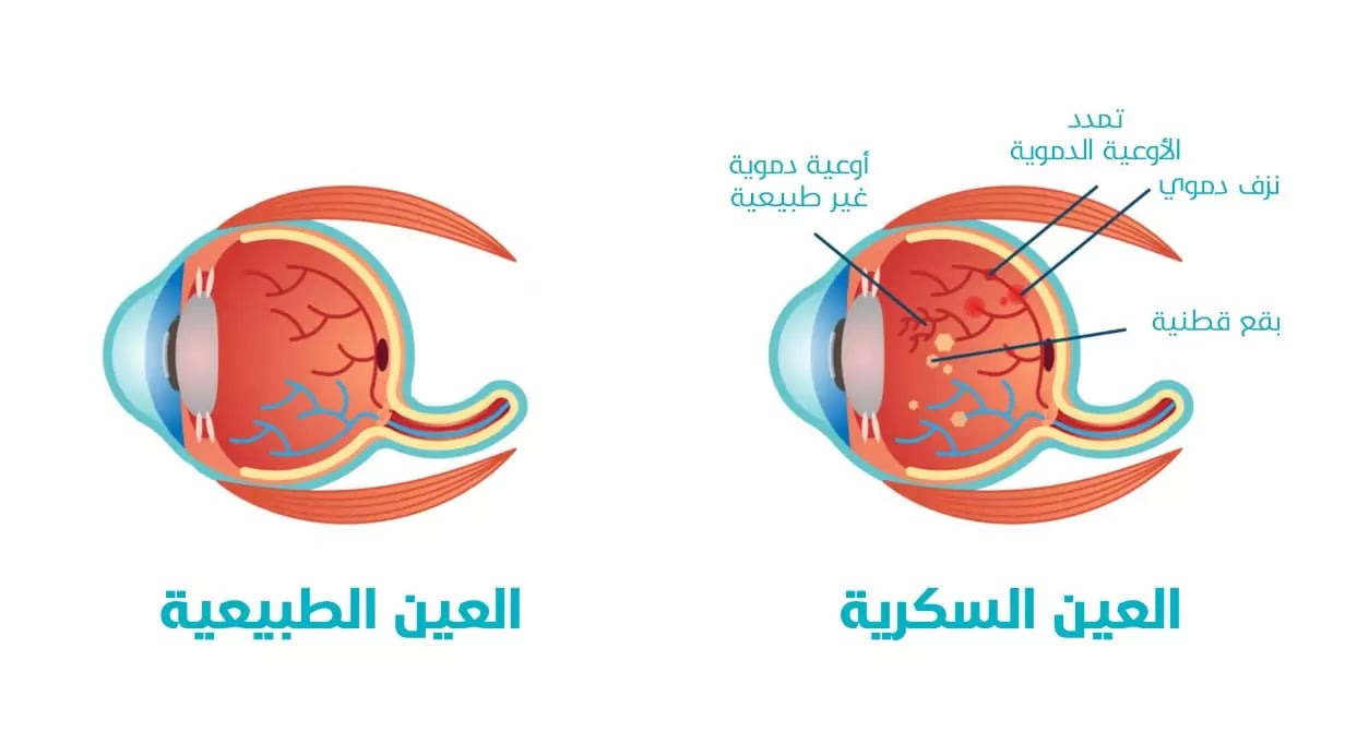 اعتلال الشبكية السكري من أسباب ضعف النظر