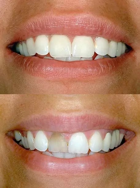 تجميل الاسنان قبل وبعد
