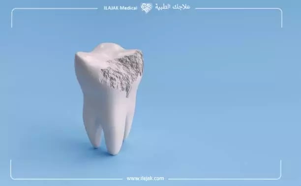 تآكل مينا الاسنان بالصور