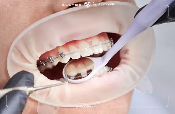 تجربتي مع تقويم الاسنان في تركيا
