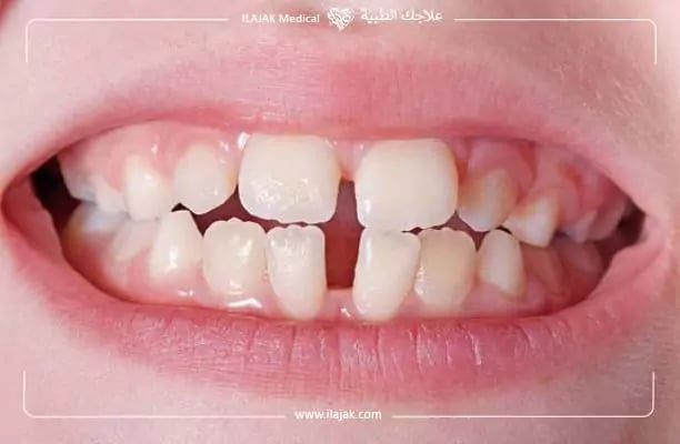 فراغات الأسنان بالصور