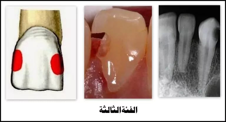 تسوس يؤثر على الأسطح الدانية من القواطع المركزية