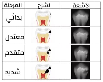 لتسوس حسب الشدة