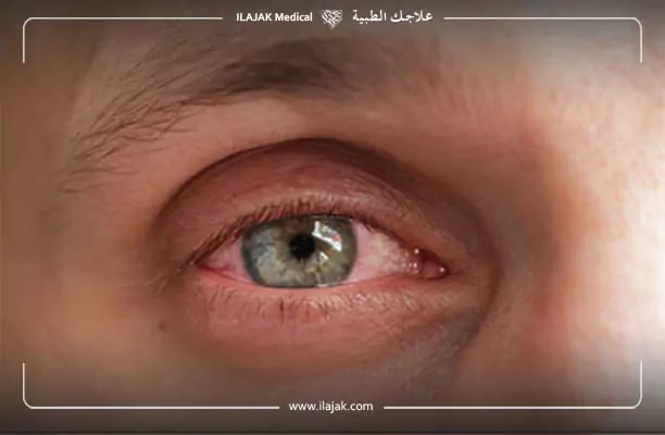 ضعف النظر المفاجئ