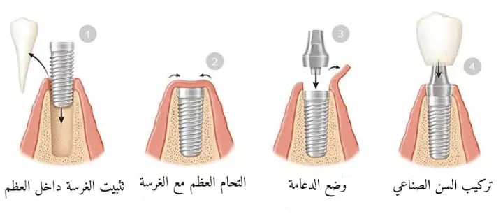 خطوات عملية زراعة الأسنان