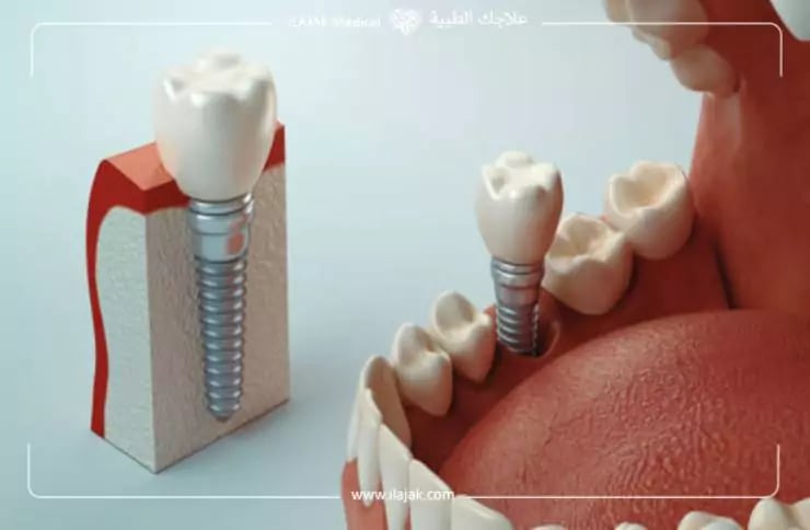 الفرق بين زراعة الاسنان وتركيب الاسنان