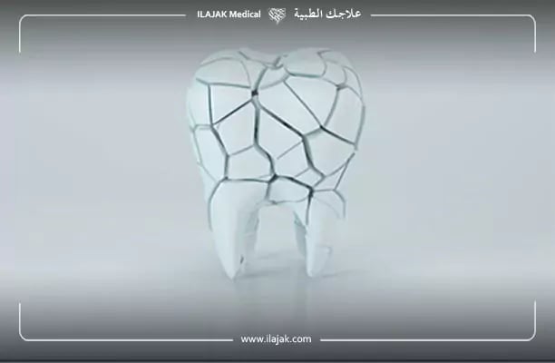 تفتت الأسنان