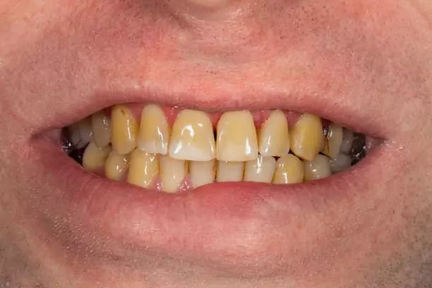 من اسباب اصفرار الاسنان التدخين