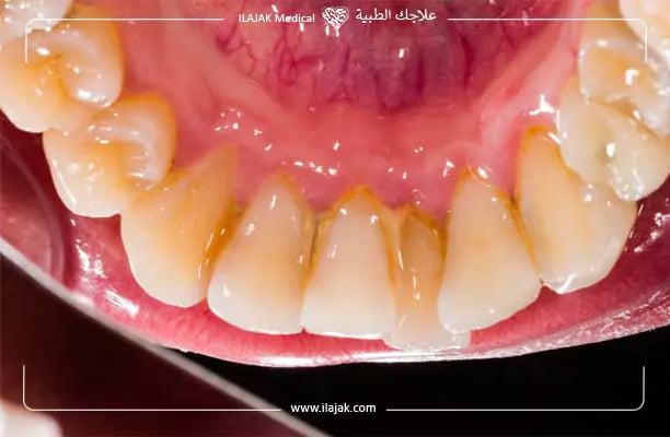 بلاك الاسنان بالصور