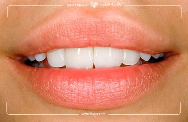 ابتسامة هوليود المتحركة
