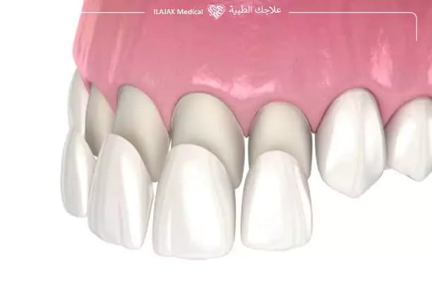 المواد المستخدمة في الفينير