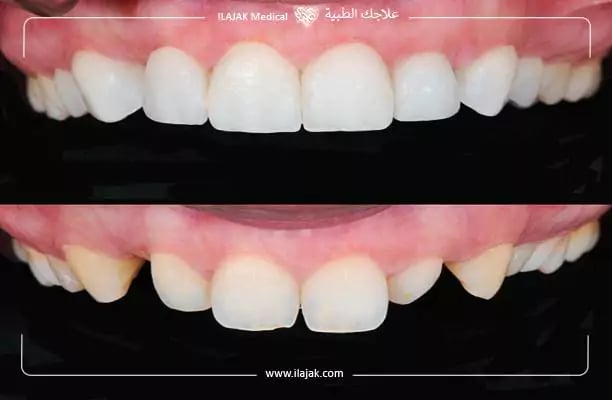 ابتسامة هوليود