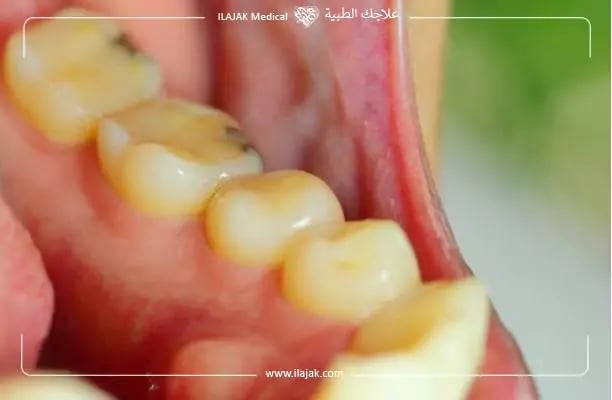 ما هو خراج الأسنان؟ الفرق بين خراج اللثة خراج الأسنان