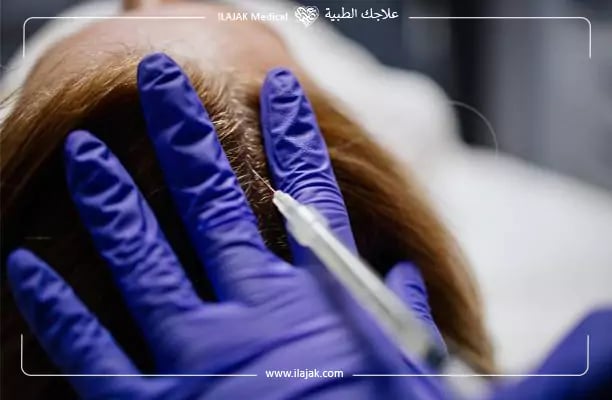 تسريع نمو الشعر المزروع