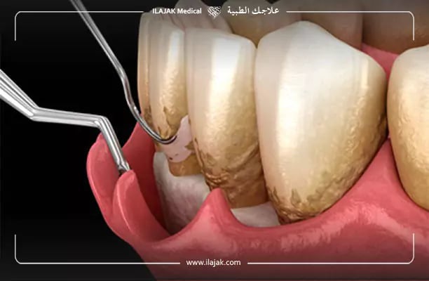 تنظيف اللثه العميق