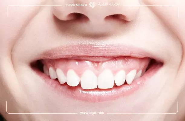 علاج الابتسامة اللثوية