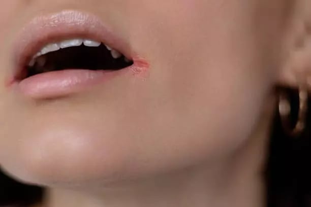 علاج التهاب الشفة الزاوي