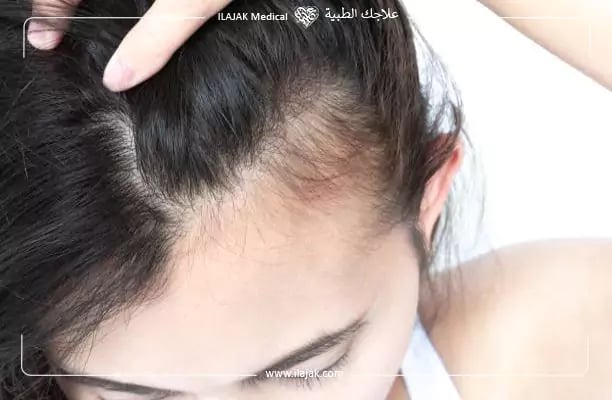 أسباب تساقط الشعر الشديد عند النساء - أسباب سقوط الشعر عند النساء