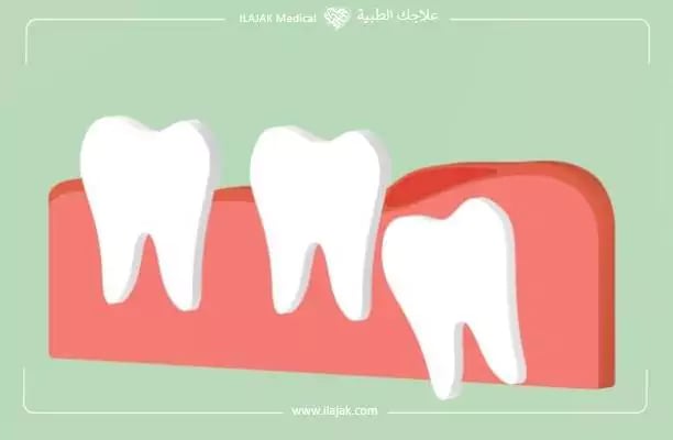 تسوس ضرس العقل: الأسباب، المضاعفات والعلاج | علاجك الطبية