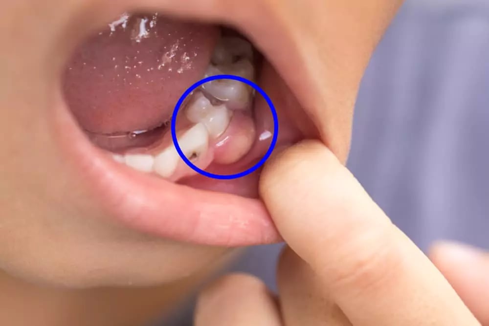 أعراض خراج الأسنان