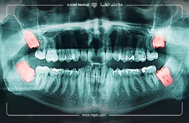 علاج خراج الأسنان عند الطبيب