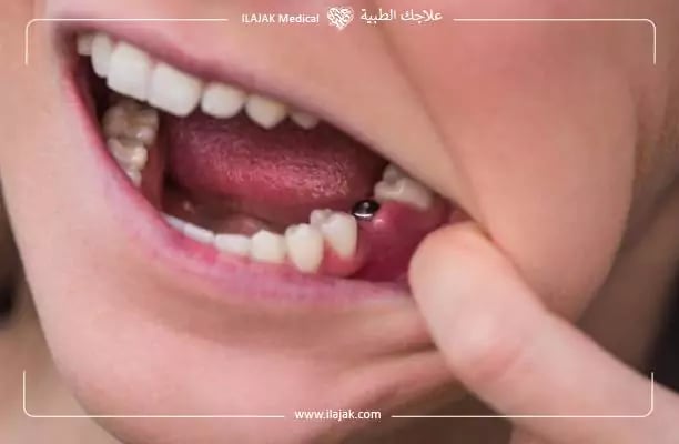 أعراض فشل زراعة الأسنان