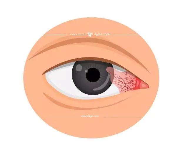 أسباب ظفر العين - لحمية العين