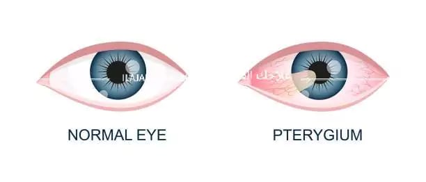 علاج لحمية العين