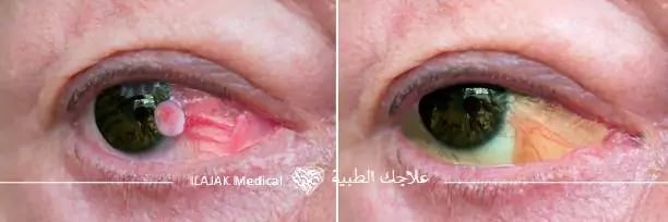 ظفرة العين قبل وبعد