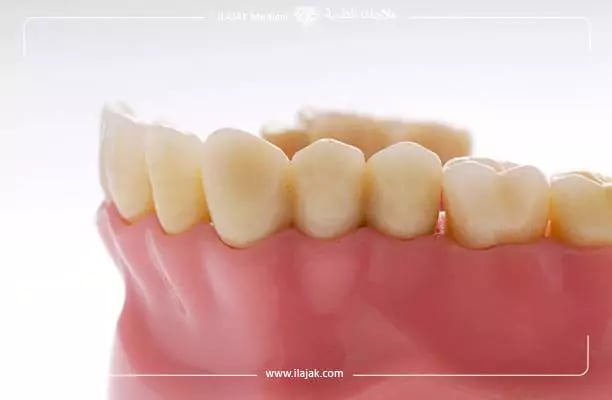 انحسار اللثة - الممنوعات بعد زراعة الأسنان