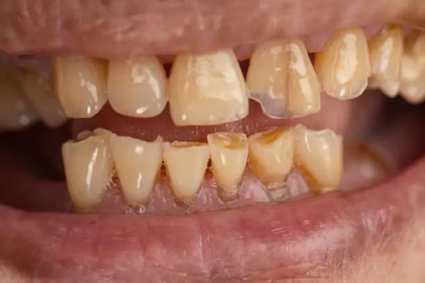 اعراض نقص الكالسيوم على الاسنان