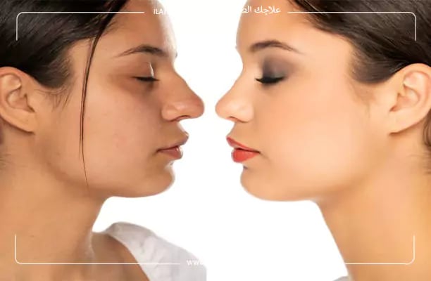 فيلر الأنف قبل وبعد