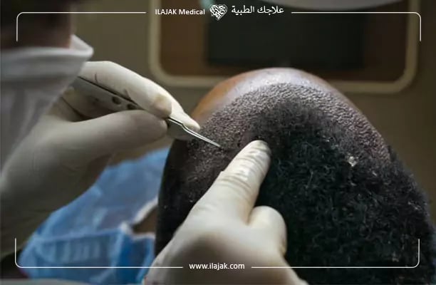 هل يمكن زراعة الشعر من شعر الجسم