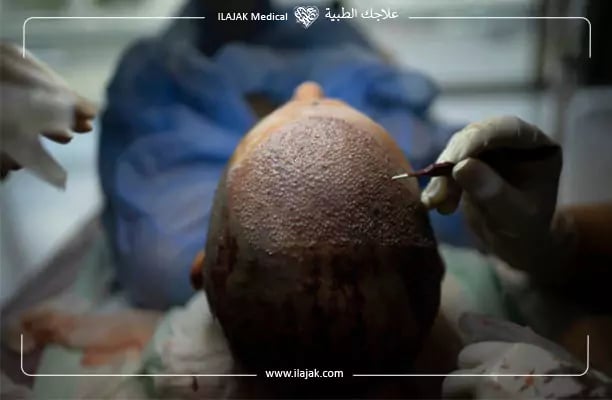 زراعة الشعر باستخدام شعر الجسم - تقنية bht لزراعة الشعر