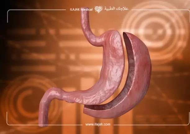أضرار عملية تكميم المعدة