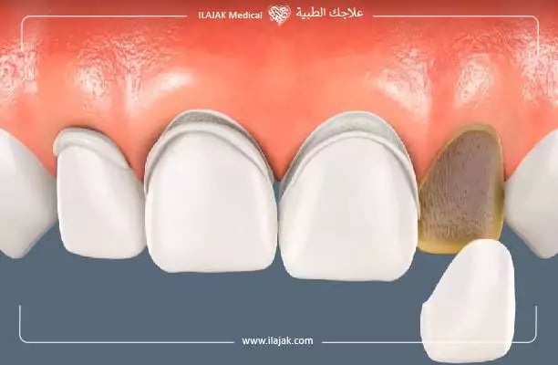 أسعار فينير الأسنان في تركيا