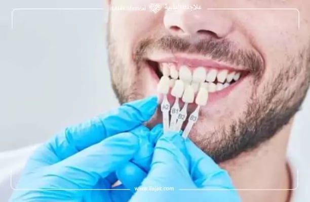 تركيب فينير الاسنان