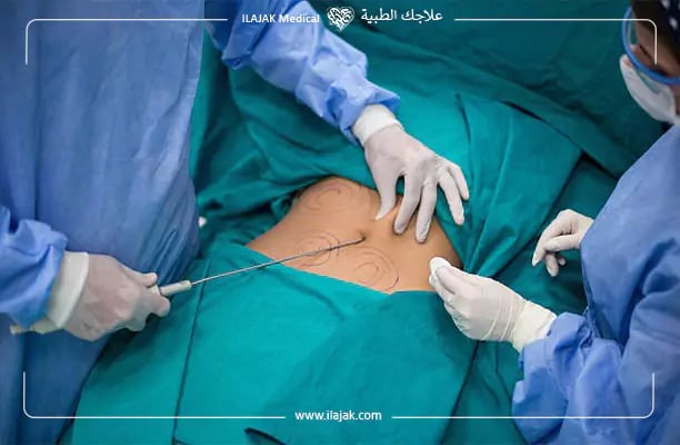 تكلفة عملية شفط دهون البطن في تركيا