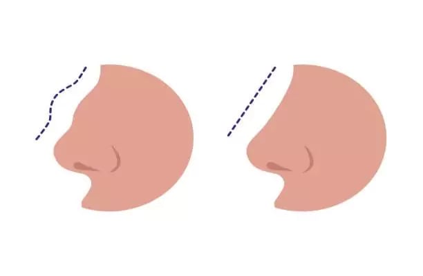 عملية تجميل الأنف في تركيا