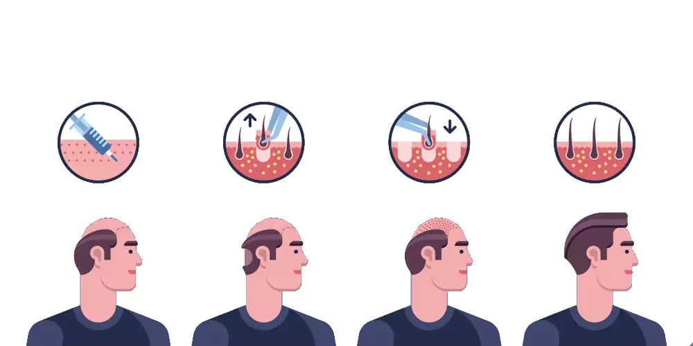 الفرق بين زراعة الشعر في مصر وتركيا