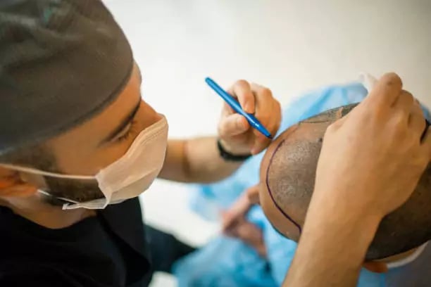 تقنية البيركوتان لزراعة الشعر