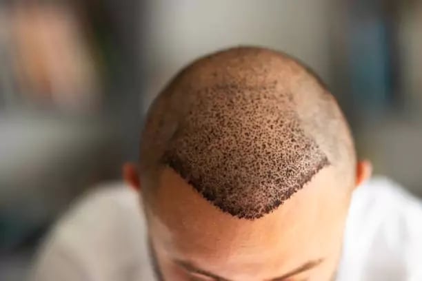 زراعة الشعر بتقنية البيركوتان