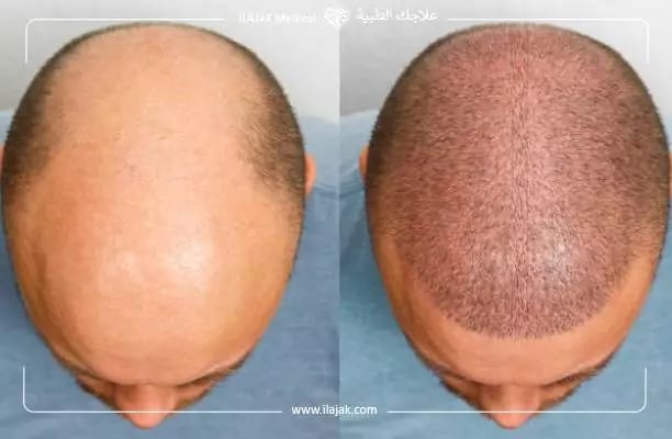 زراعة الشعر قبل وبعد بالصور