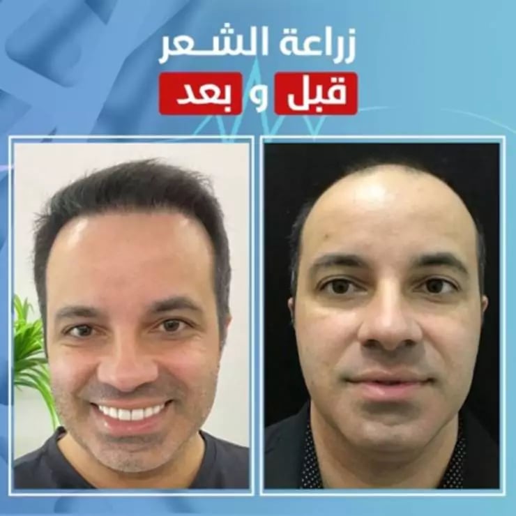 زراعة الشعر في اسطنبول قبل وبعد