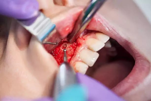 علاج كيس الاسنان