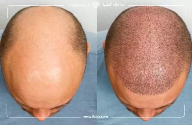 نتائج عملية زراعة الشعر بالصور