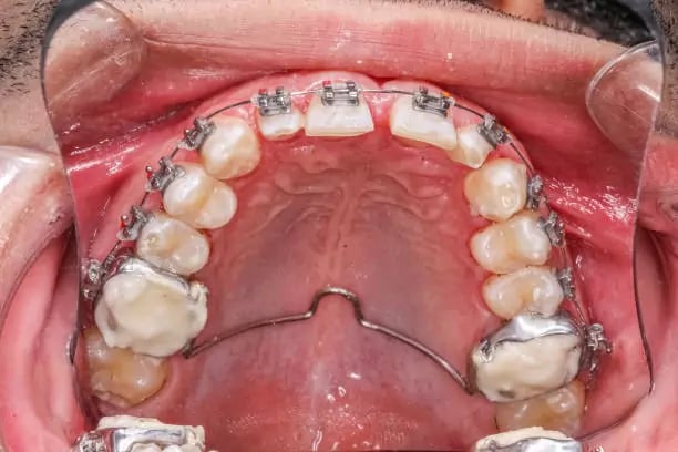 جهاز موسع الفك, موسع الفك العلوي للكبار والاطفال