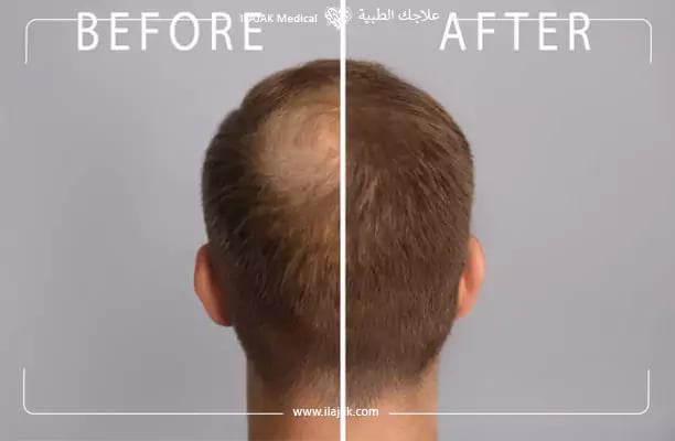 نتائج ميزوثيرابي للشعر قبل وبعد